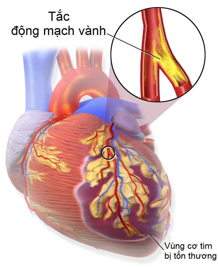 Nhồi máu cơ tim xảy ra khi 1 hoặc nhiều nhánh động mạch vành bị tắc nghẽn