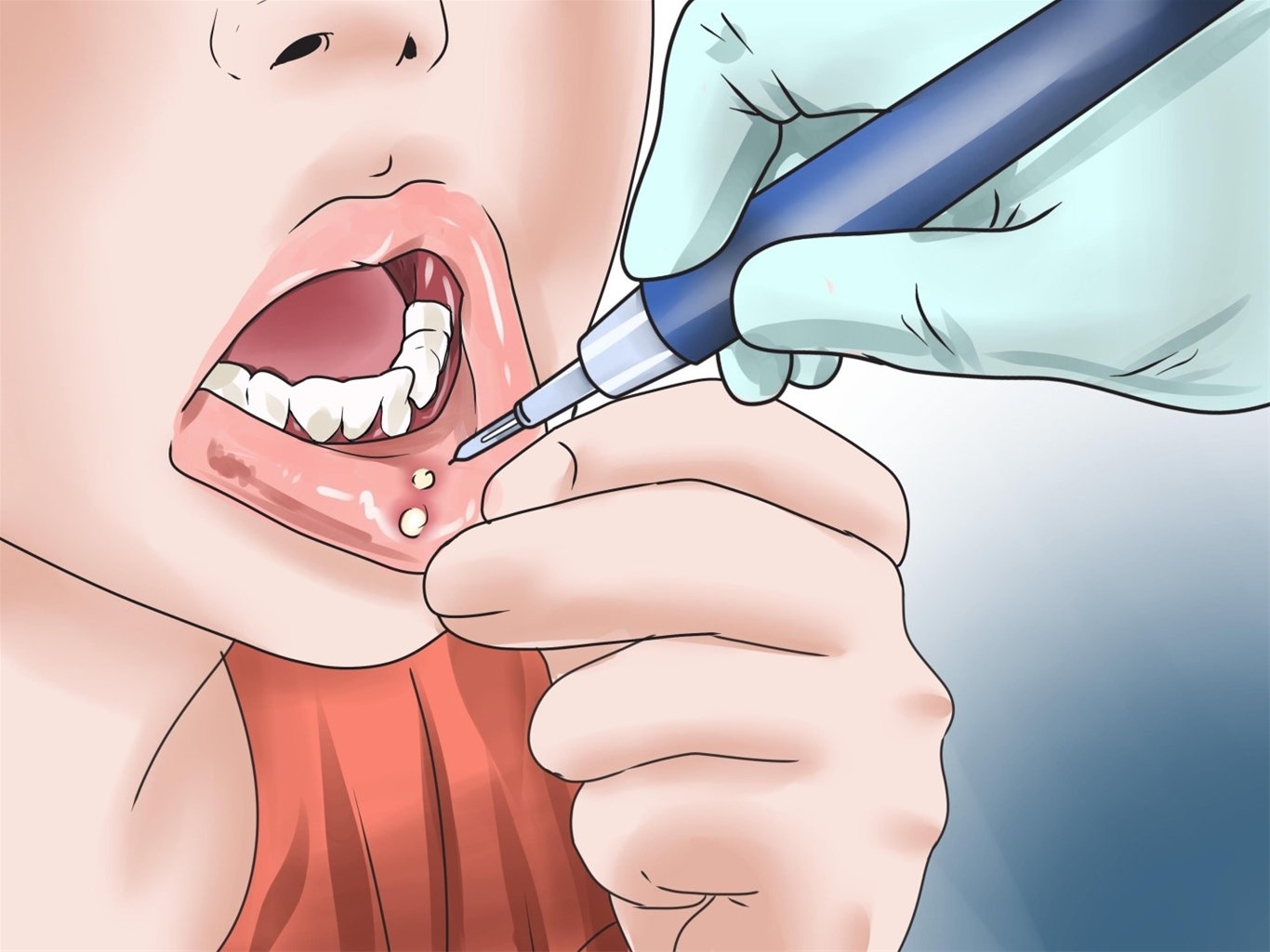 Nguyên nhân gây ra viêm loét miệng lưỡi là do nhiễm nấm, vi khuẩn hay virus