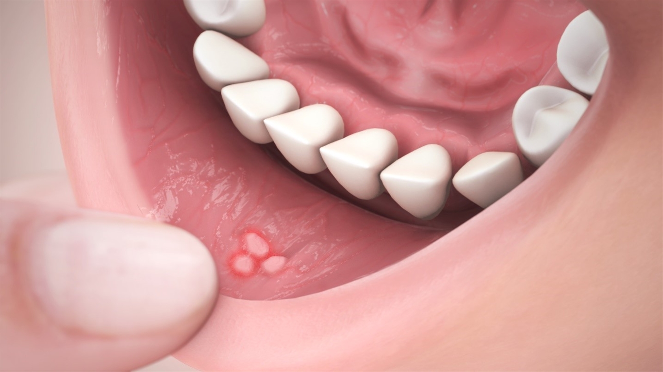 Viêm loét miệng lưỡi gây ra những vết loét tròn,có màu vàng, xung quanh viền đỏ