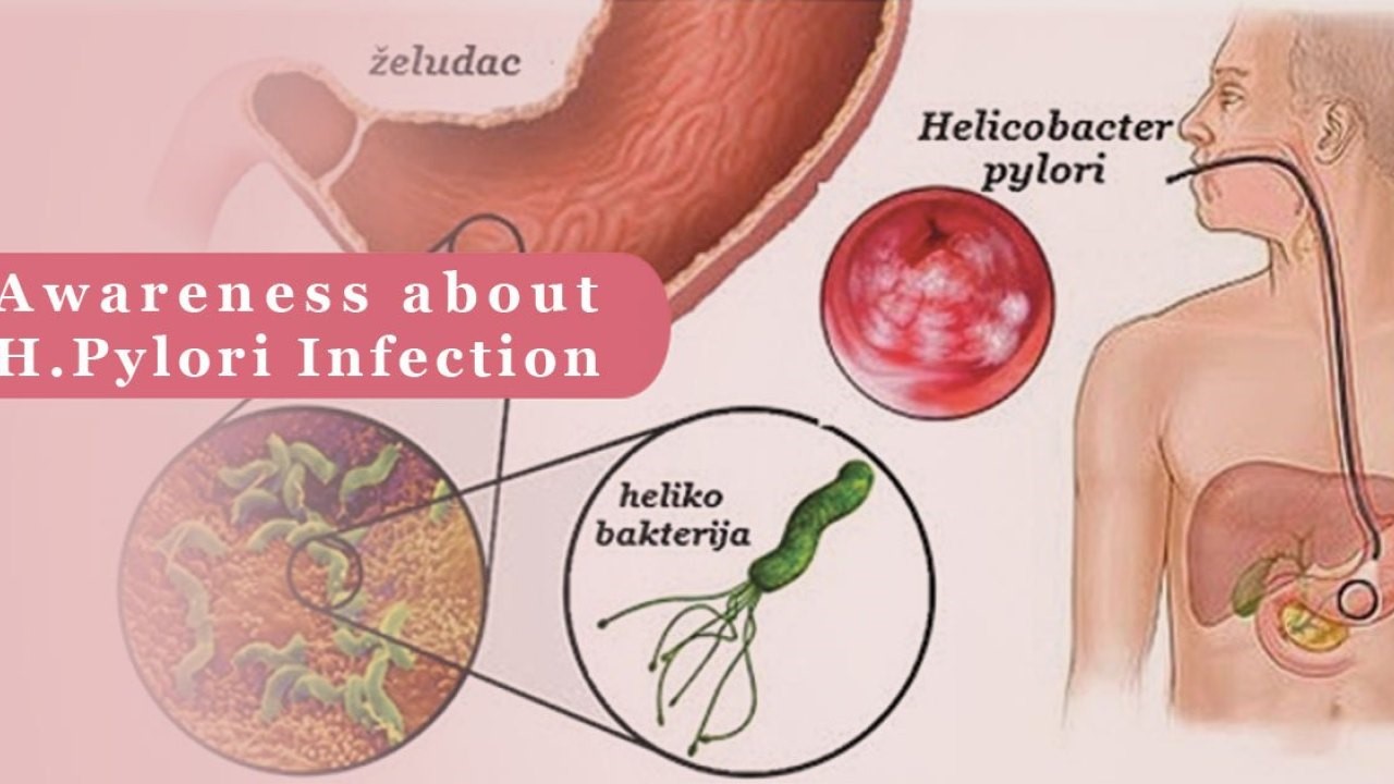 Sintomas helicobacter pylori cansancio