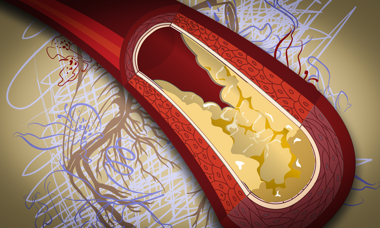Tăng LDL-Cholesterol khiến hình thành mảng xơ vữa, tăng nguy cơ đột quỵ