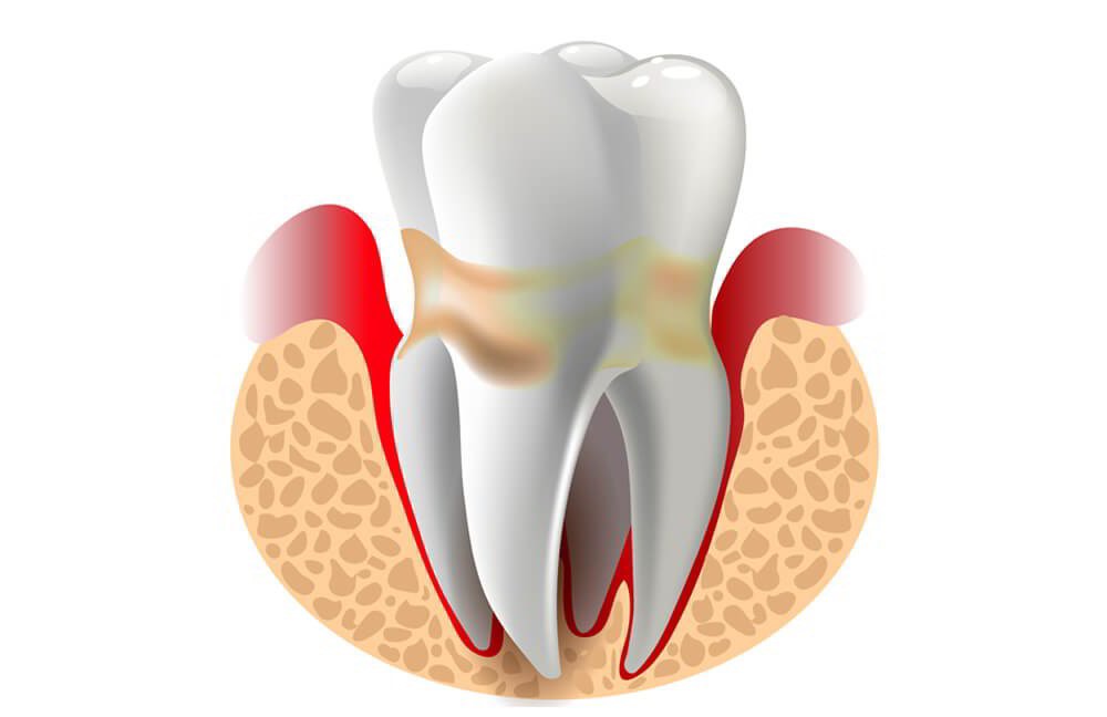 Mảng bảm, cao răng (vôi răng) tạo điều kiện cho vi khuẩn trú ẩn