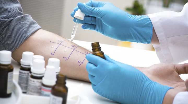 Tìm tác nhân gây dị ứng để thực hiện phương pháp "giải mẫn cảm"