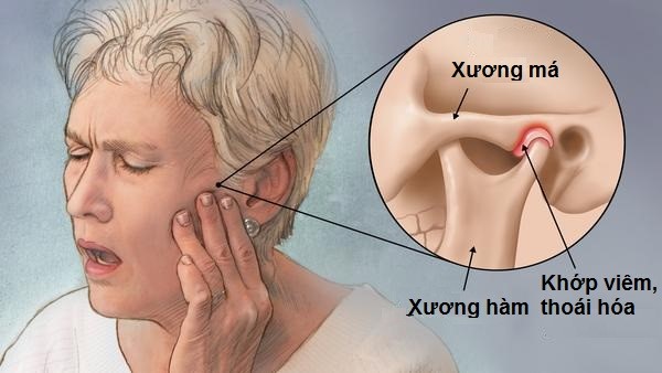 Viêm khớp nói chung, thoái hóa khớp có thể là nguyên nhân gây viêm khớp thái dương hàm