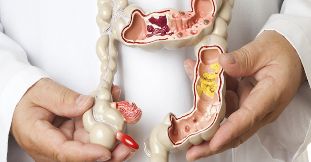 Bệnh lý đại tràng thường gây nên chứng rối loạn tiêu hóa