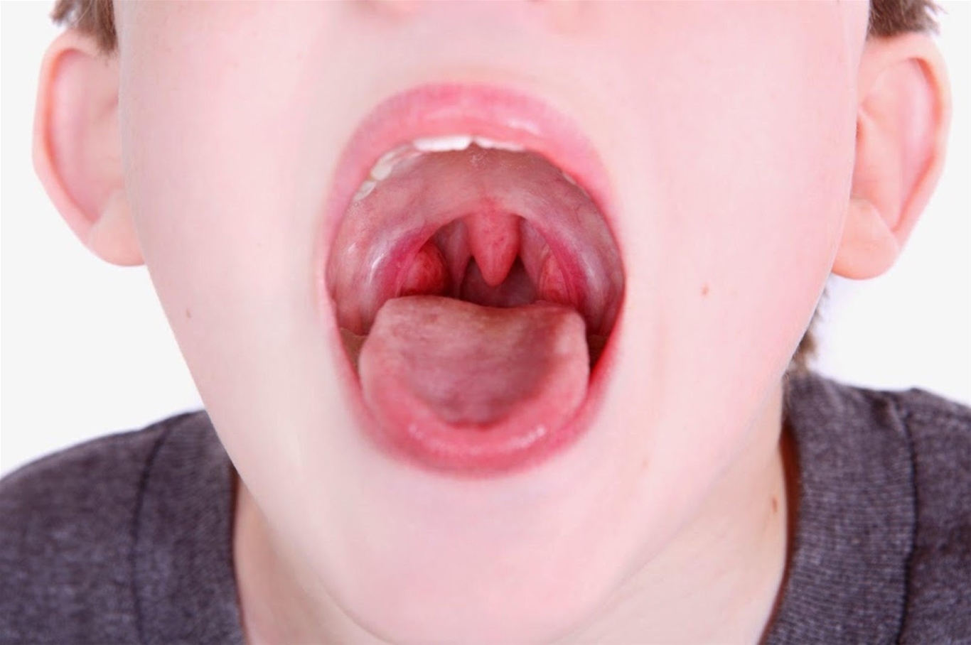 Niêm mạc họng tấy đỏ là một trong những triệu chứng của viêm mũi họng xuất tiết