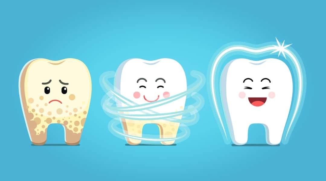 Để loại bỏ cao răng, cần phải đến gặp nha sĩ