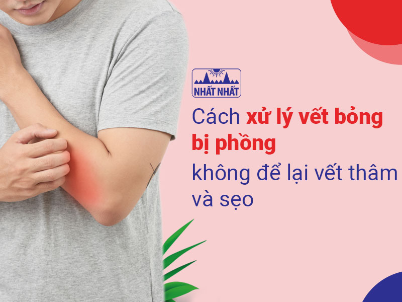 vết bỏng bị phồng