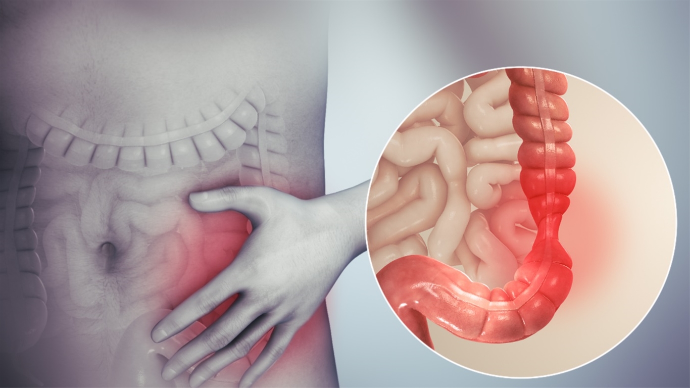 Ăn xong đau bụng đi ngoài do hội chứng ruột kích thích