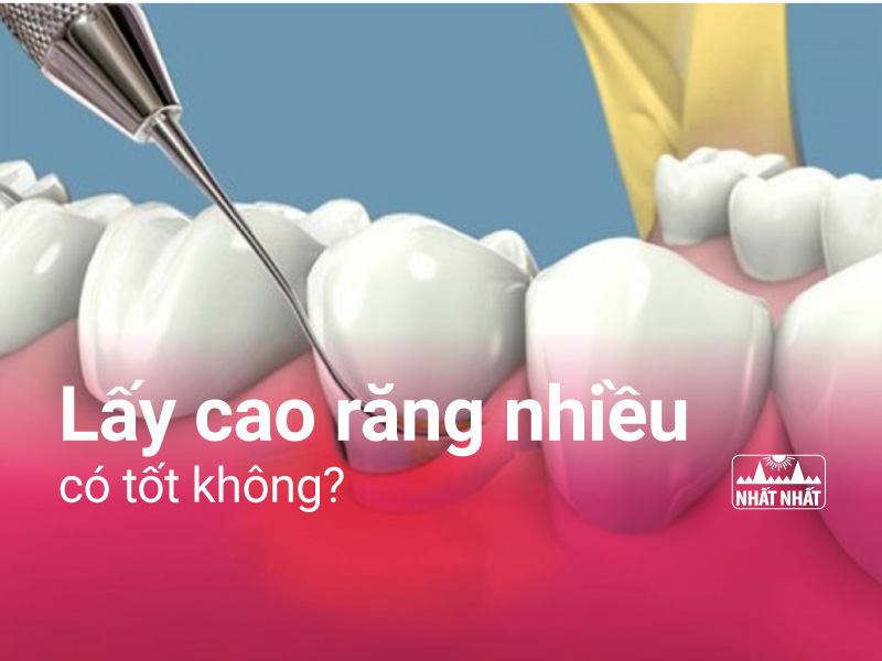 lấy cao răng nhiều có tốt không