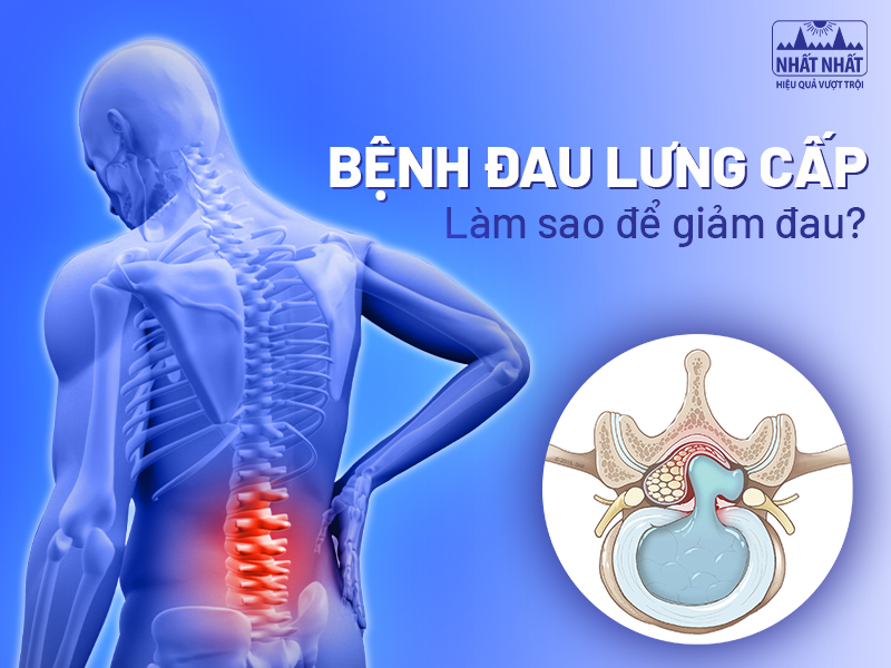 Bệnh đau lưng cấp - Làm sao để giảm đau?