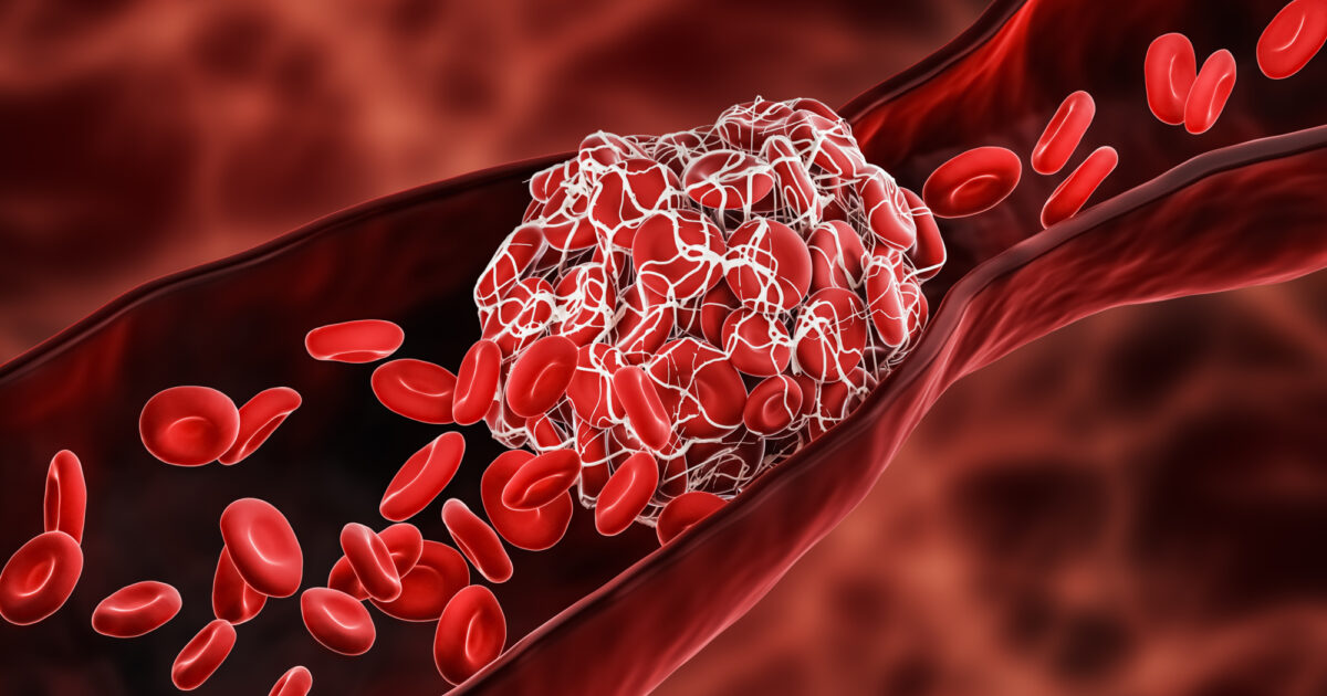 Các cục máu đông gây tắc nghẽn trong các mạch máu