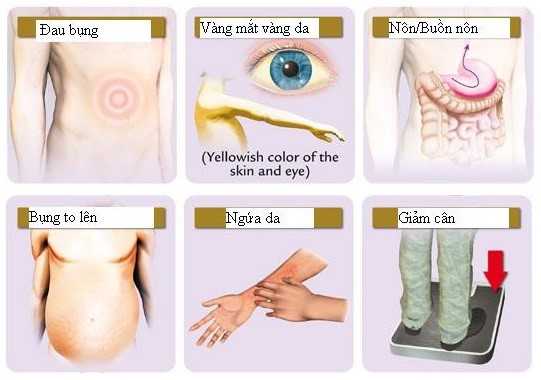 Các triệu chứng ung thư gan thường thấy