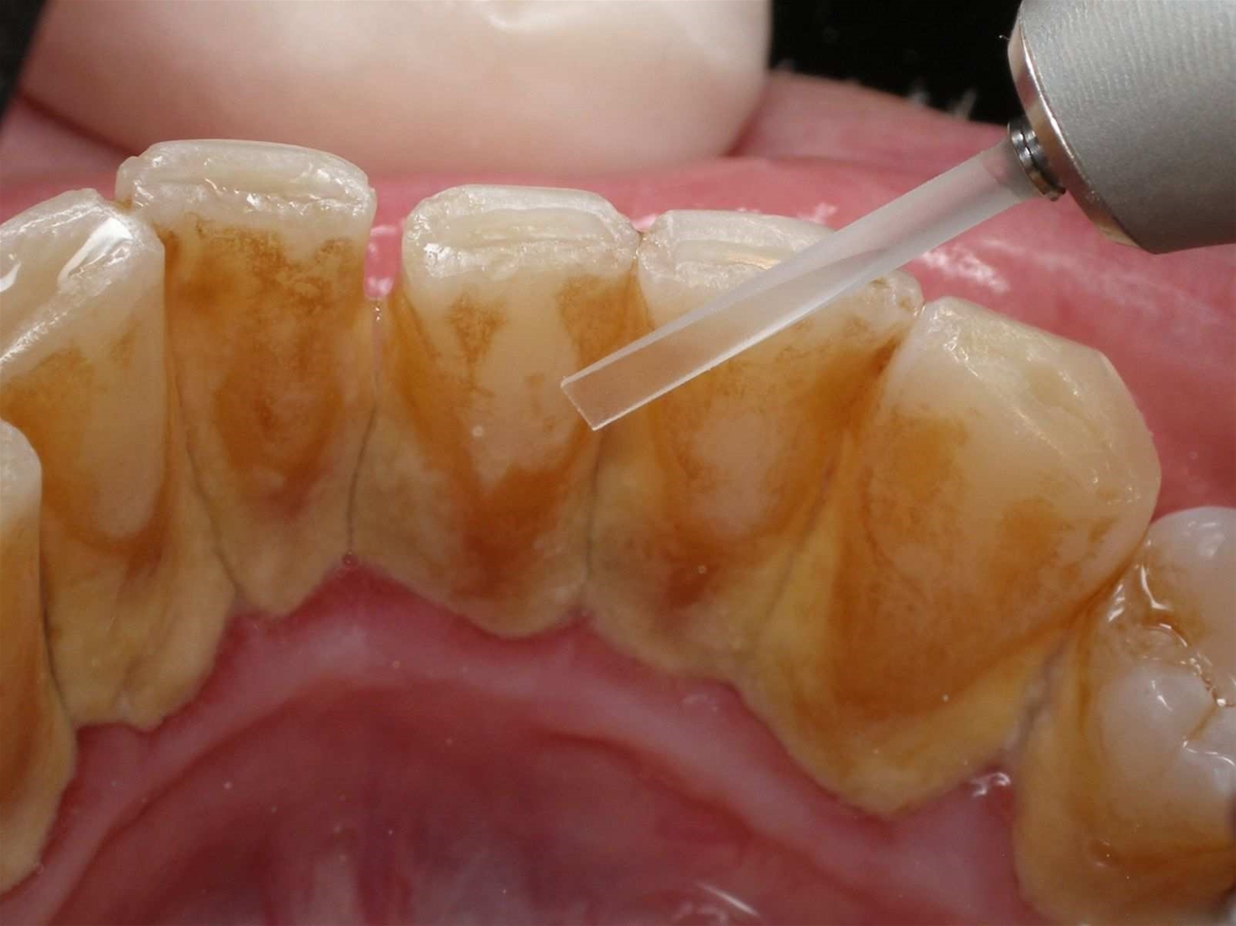 Cao răng hay vôi răng là mảng bám răng cứng lại trên răng