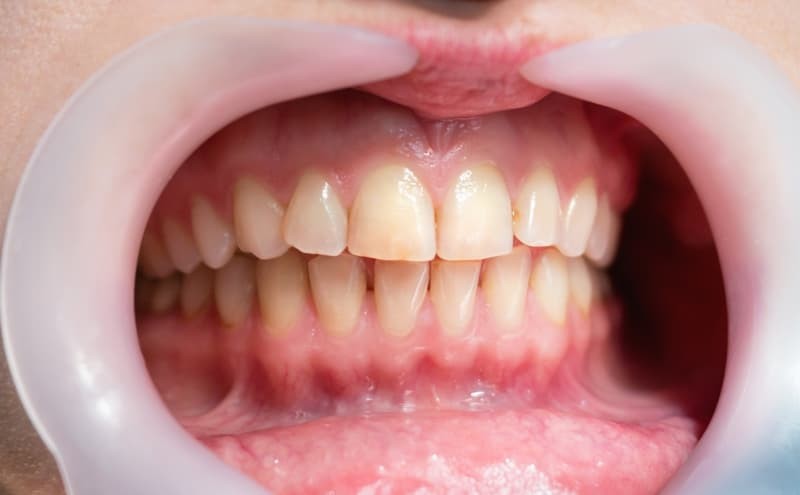 chảy máu chân răng liên tục