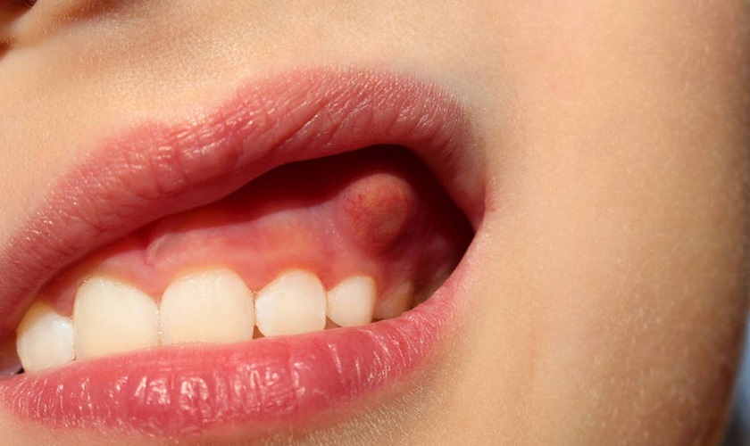 Có nhiều nguyên nhân khiến viêm sưng nướu răng có mủ