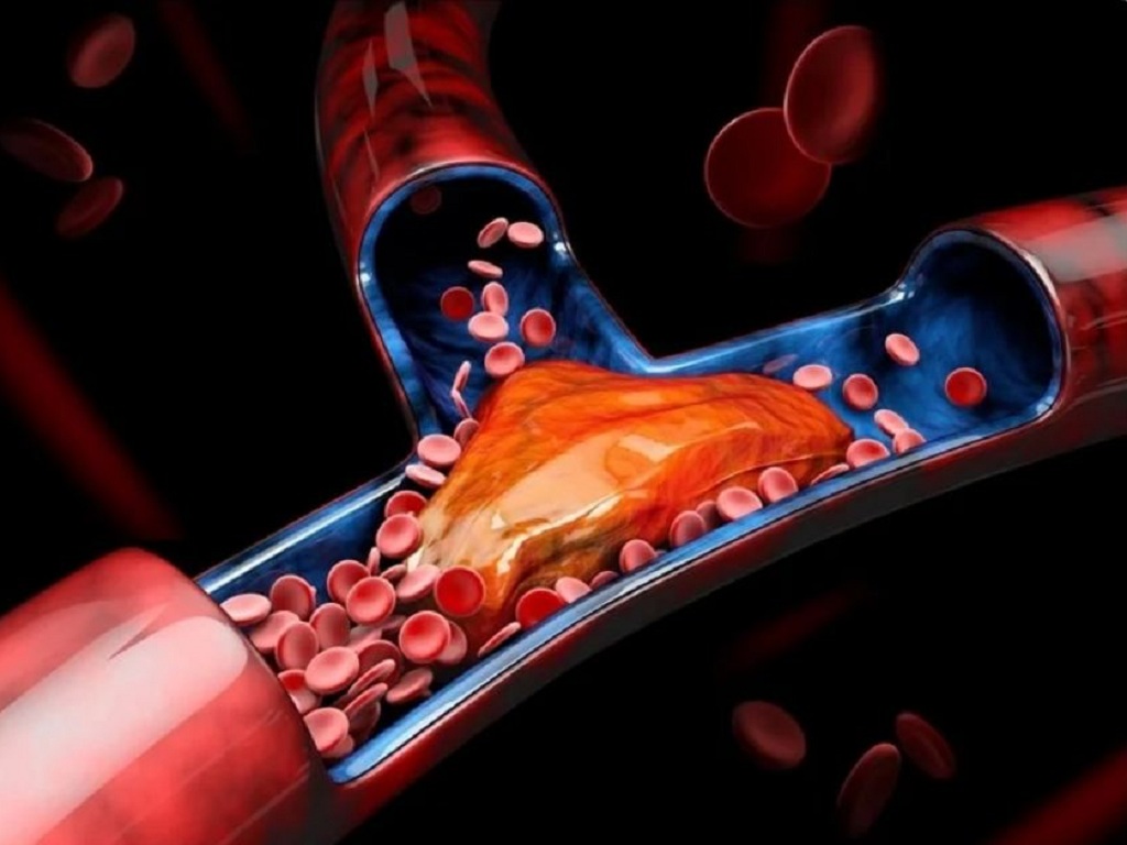 Cục máu đông còn được gọi là huyết khối hình thành trong các mạch máu