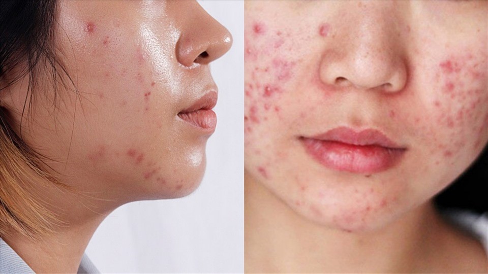 Da dầu dễ bị mụn trứng cá