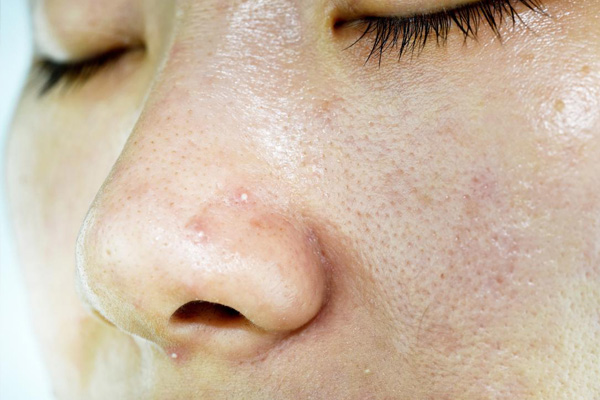 Dấu hiệu nhận biết da nhờn và cách phòng ngừa hiệu quả