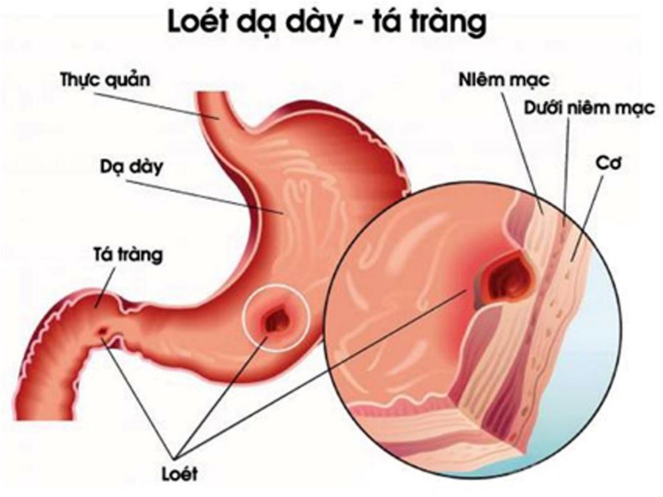 đau dạ dày là đau ở đâu