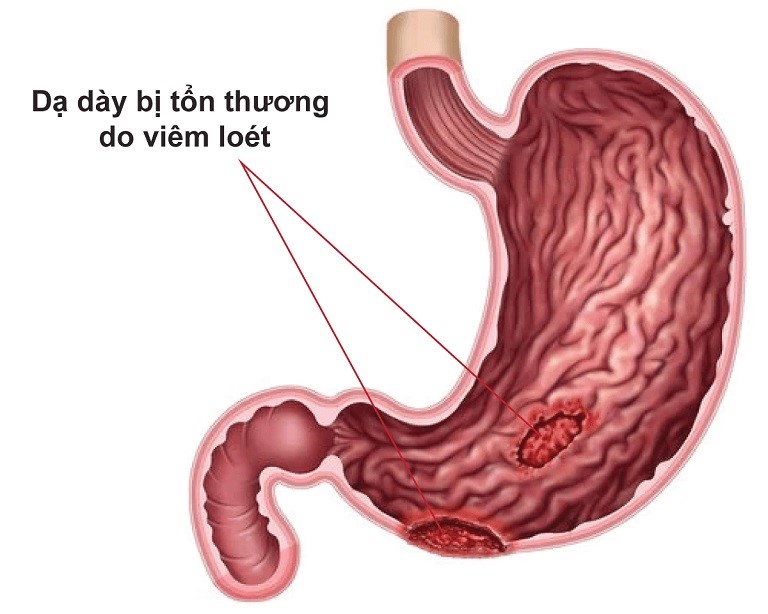 đau dạ dày đầy hơi