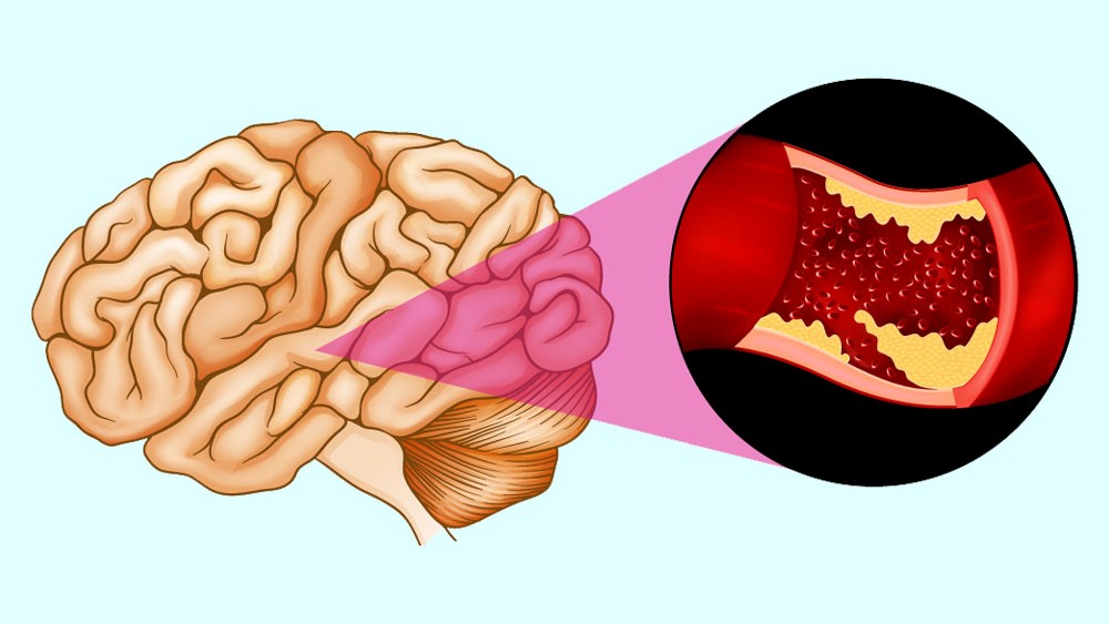 đau đầu dữ dội