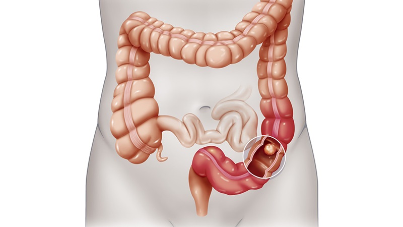 Đau quặn bụng tiêu chảy có thể là dấu hiệu của ung thư đại tràng