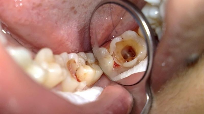 Đau răng hàm dưới bên trái 