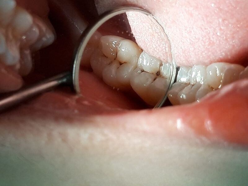 đau răng nổi hạch