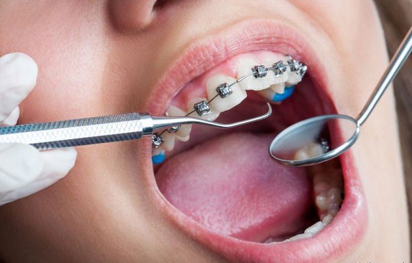 Đeo niềng răng gây khó vệ sinh răng miệng, dễ hình thành cao răng
