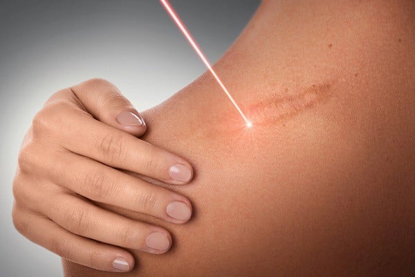 Điều trị bằng laser sử dụng chùm ánh sáng tập trung để loại bỏ sẹo