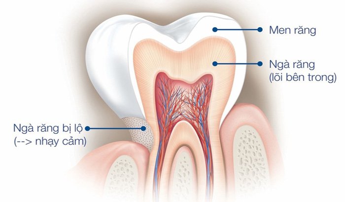 Ê buốt răng do ngà răng bị lộ, gây kích thích dây thần kinh
