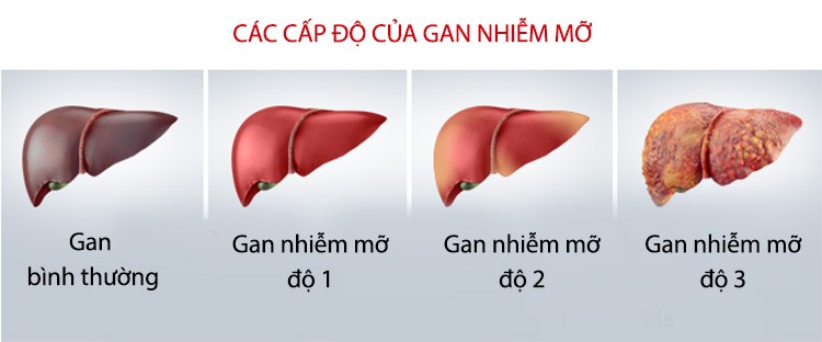 gan nhiễm mỡ độ 1