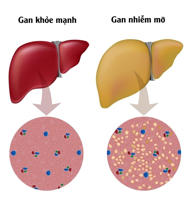  giải độc gan sau khi uống bia rượu