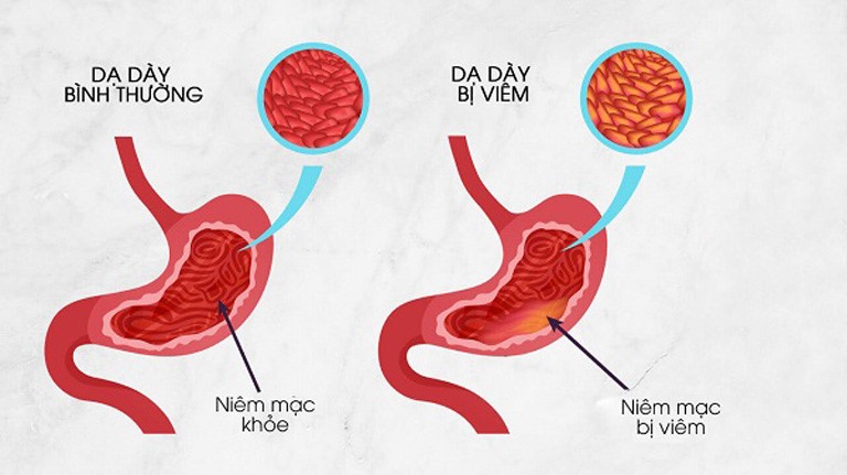 Hình ảnh dạ dày bị viêm