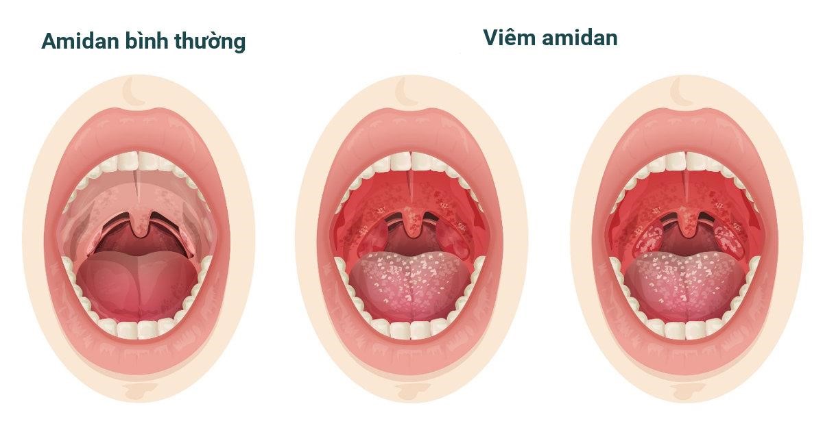 Họng bình thường và viêm amidan