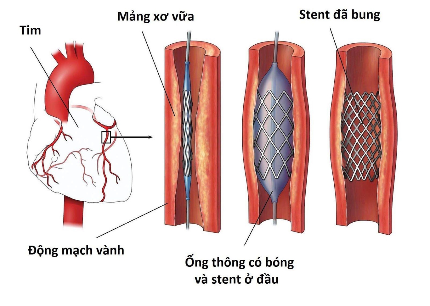 Kỹ thuật đặt stend mạch vành