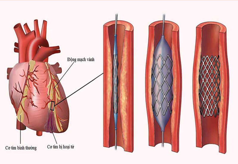 Kỹ thuật đặt stent mạch vành