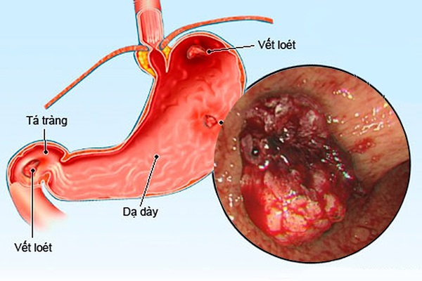 Loét dạ dày ở bệnh nhân xơ gan