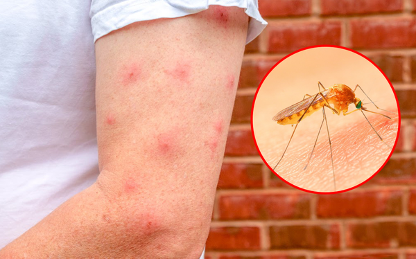 Muỗi đốt gây ngứa ngáy và nhiều bệnh nguy hiểm