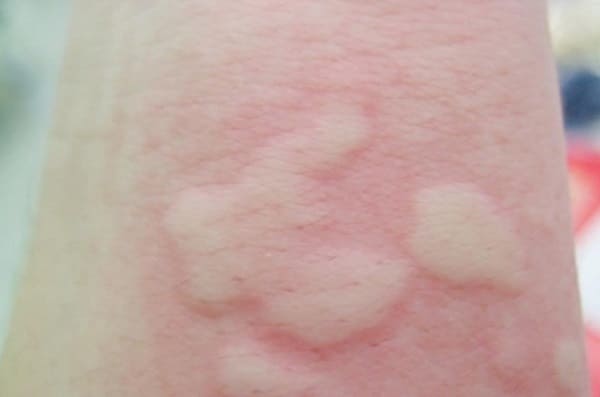 Muỗi đốt gây sưng tấy và nổi cục trên da