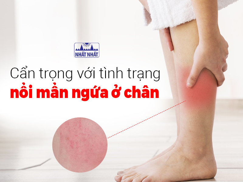 Muốn điều trị đúng cách cần hiểu rõ nguyên nhân nổi mẩn ngứa ở chân