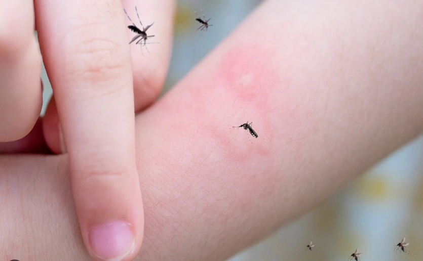 Ngứa là phản ứng của cơ thể đối với các chất gây kích ứng từ muỗi