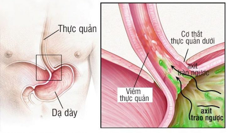 ợ chua nóng rát cổ