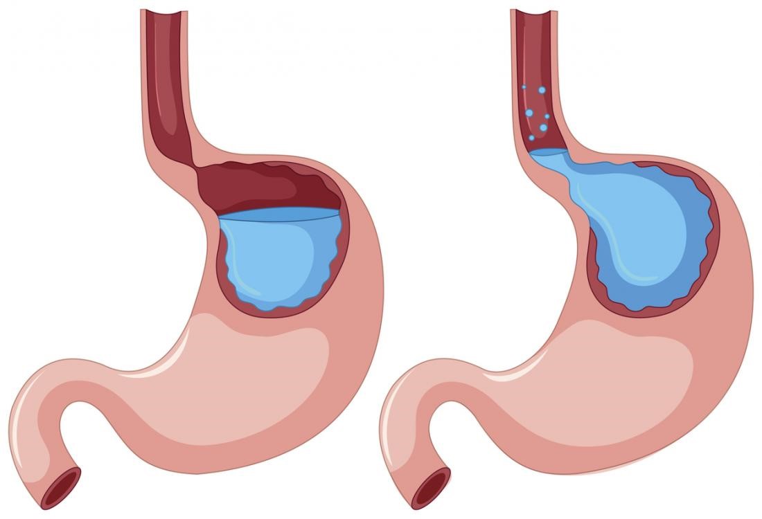 Bất thường van đóng giữa thực quản và dạ dày gây ra hiện tượng ợ chua