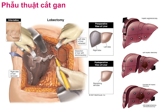 Phẫu thuật cắt gan nhằm loại bỏ tế bào khối u