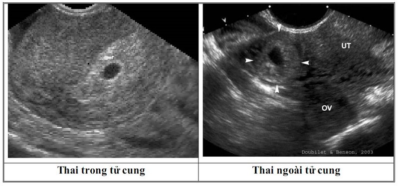 que thử thai 2 vạch