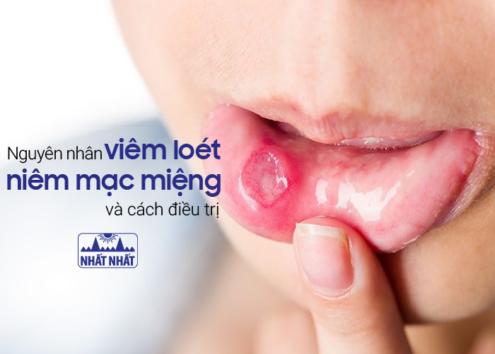 Viêm loét niêm mạc miệng