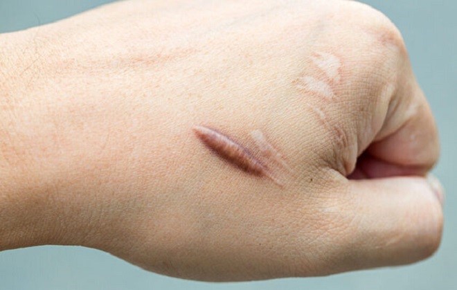 Sẹo lồi hình thành khi vết thương trên da lành lại