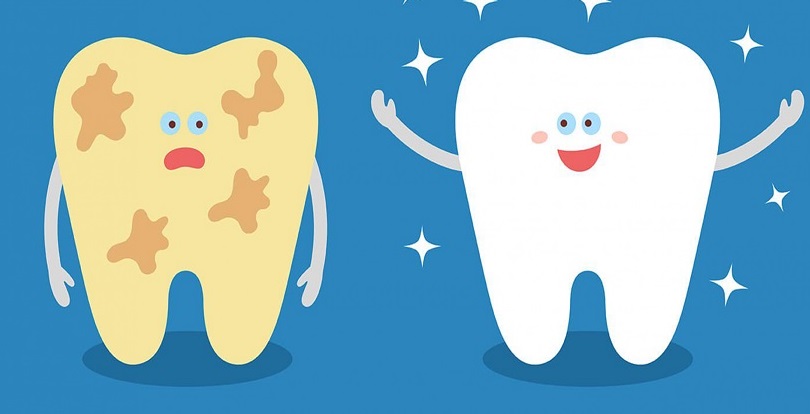 Tìm hiểu cách loại bỏ mảng bám trên răng